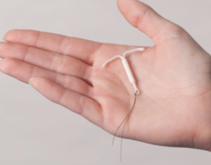 IUS（ミレーナ）